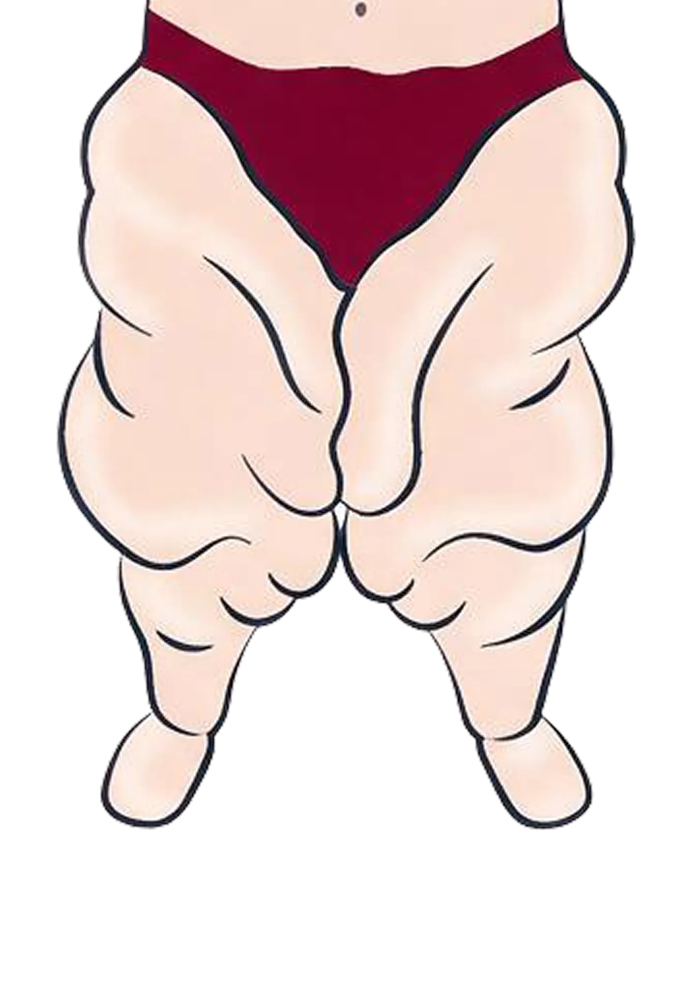 Representação do estágio IV do lipedema ou lipolinfedema