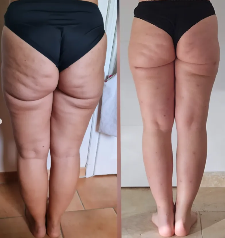 Exemplo clínico da manifestação do lipedema nas pernas