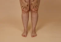 lipd linfedema