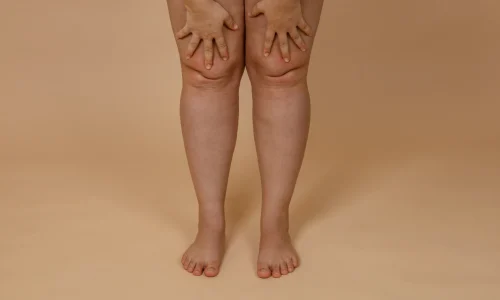 lipd linfedema