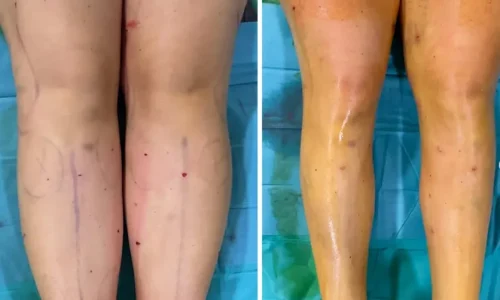 lipedema piernas 3